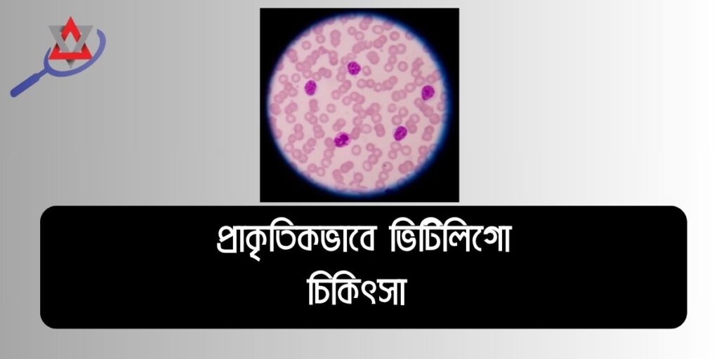 শ্বেতী রোগের স্থায়ী চিকিৎসা: কারণ, লক্ষণ ও সমাধান