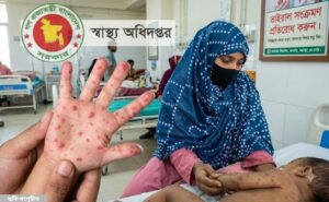 হামে প্রাণহানি বেড়েই চলেছে ২৪ ঘণ্টায় আরও ৪ শিশুর মৃত্যু