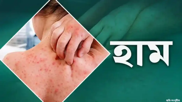 ২৪ ঘণ্টায় হামের উপসর্গে ৫ শিশুর মৃত্যু, নতুন শনাক্ত ১৮৭