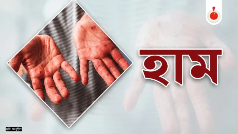 হামে আরও এক শিশুর মৃত্যু, উপসর্গে প্রাণ গেল ৪ জনের