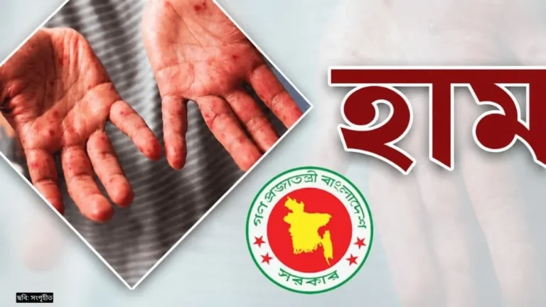 হাম ও উপসর্গে ৯২২ জনের মৃত্যু, নতুন শনাক্ত ১ হাজার ১৮